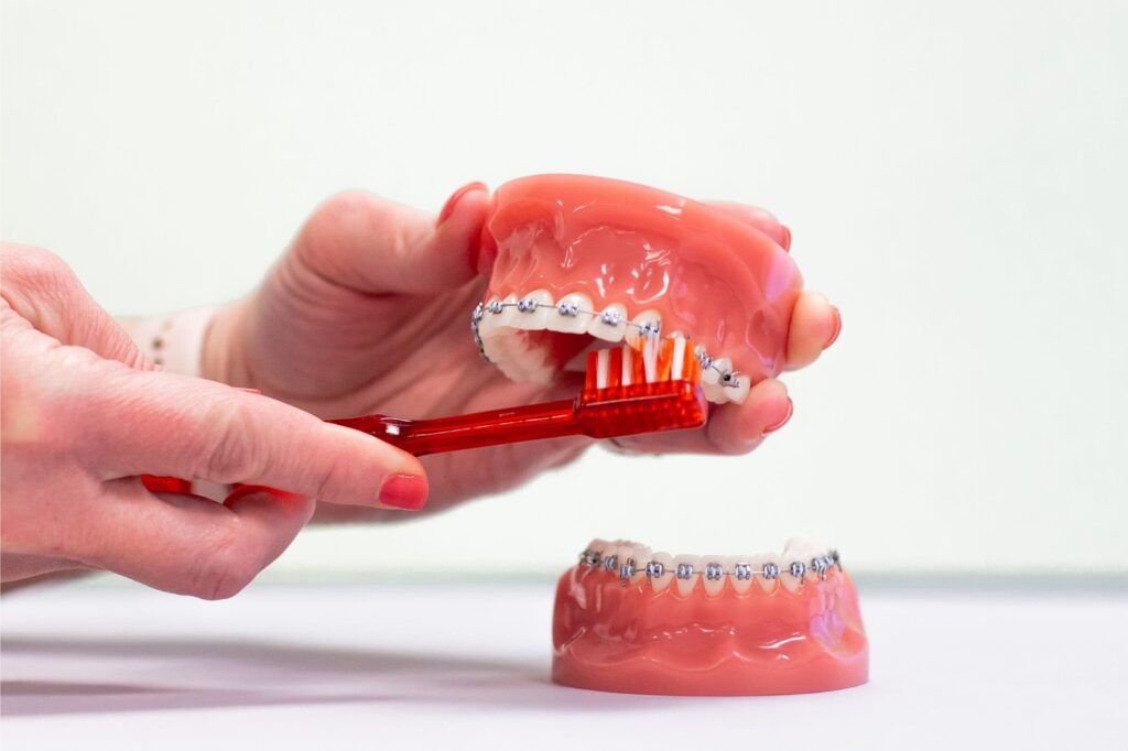 What Can I Eat With Braces? A Complete Food Guide